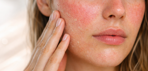 Cuidados com a pele pós-Carnaval: por que um protocolo calmante e reparador faz toda a diferença