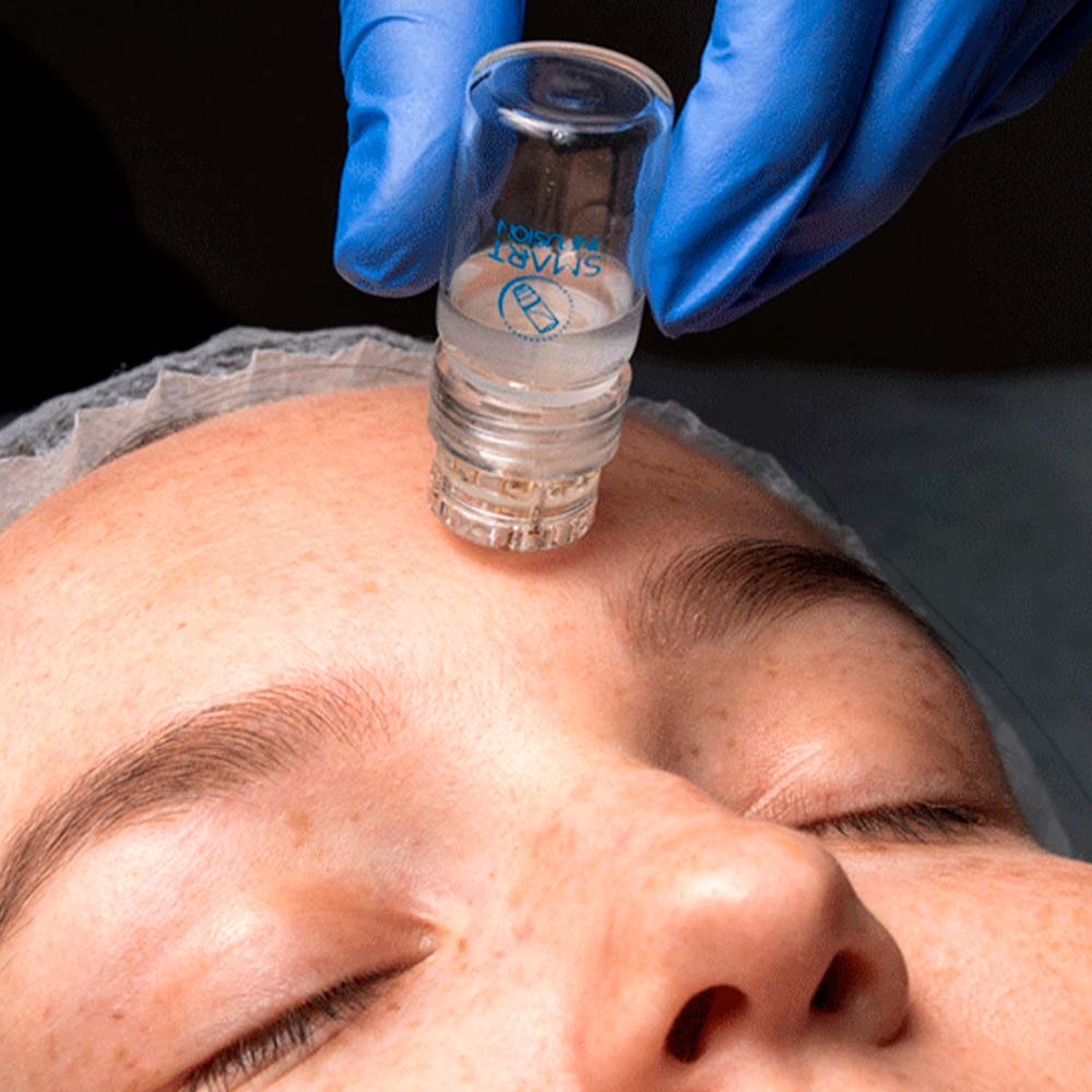 Smart Infusion Microagulhamento, 1,00 mm — modo de aplicação, Smart GR