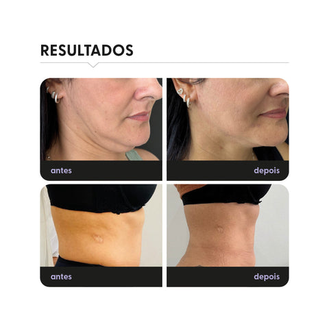 Smart Deep Laser 15W, 1470nm, Endolaser — embalagem do produto, Smart GR