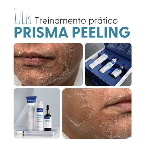Treinamento Prático, Prisma Peeling, Smart GR